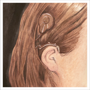 Cochlear Implant Print