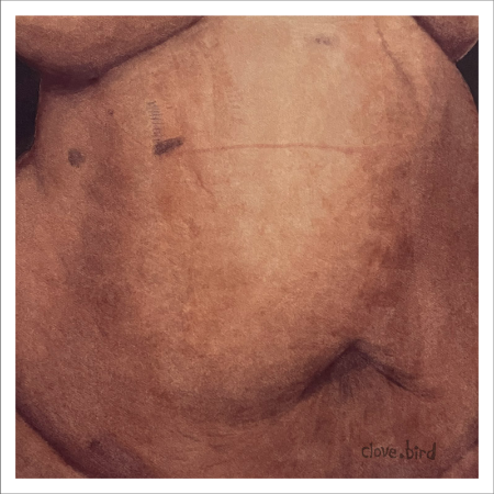 Gallbladder Scar Print